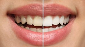 口腔美白市场展望:颜值经济新赛道